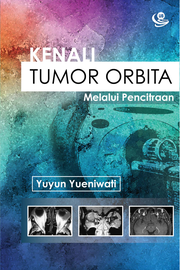 Kenali Tumor Orbita melalui Pencitraan